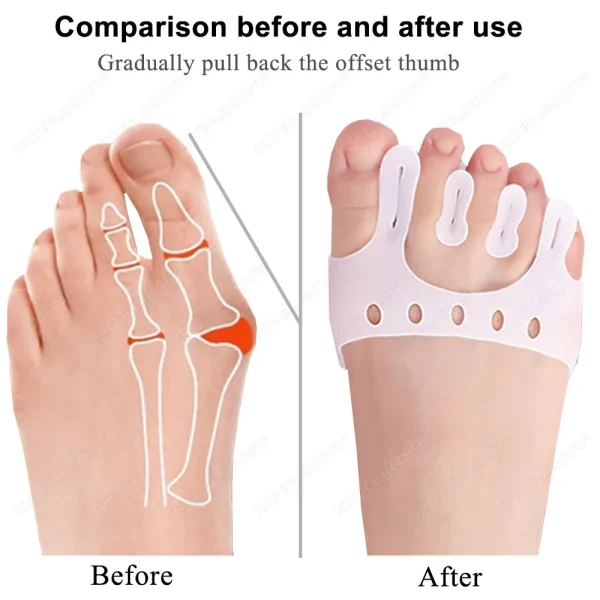Five Toe Separator Hallux Valgus Corrector Thickened Forefoot Cushion Pressure Relief Massage Toe Overlap Corrector Pad Care - Image 2